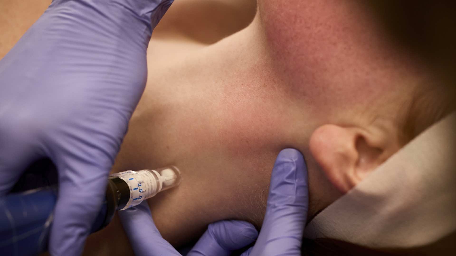 SkinPen Microneedling for Neck Wrinkles