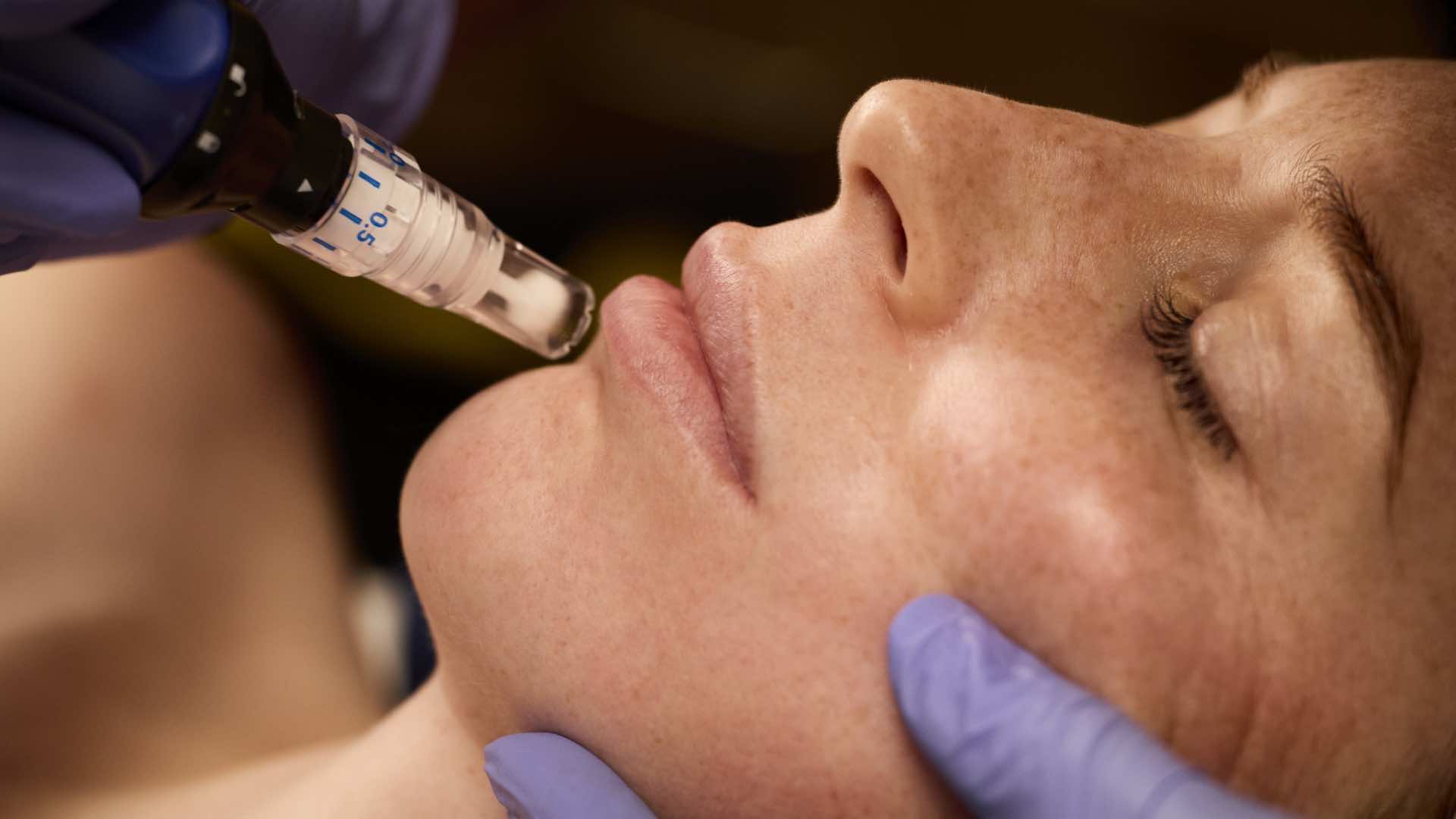 SkinPen Microneedling for Acne Scar Treatment